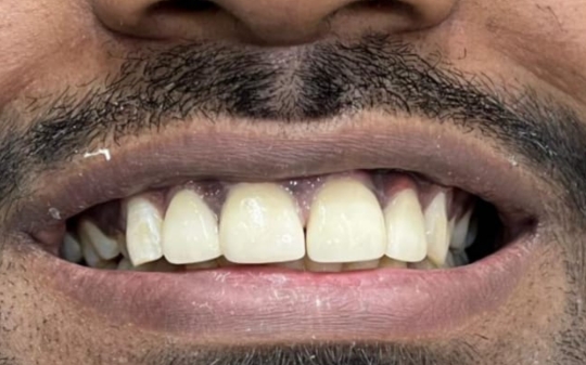 After Dental Treatment