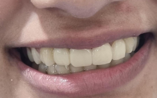 After Dental Treatment