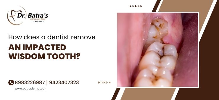 wisdom tooth removal
