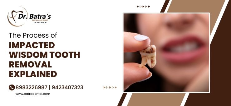 wisdom tooth removal in Bhandara